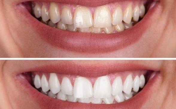 Pengertian dan Manfaat Prosedur Bleaching Gigi